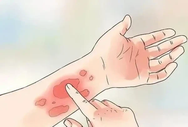 荨麻疹：病因、诊断及管理