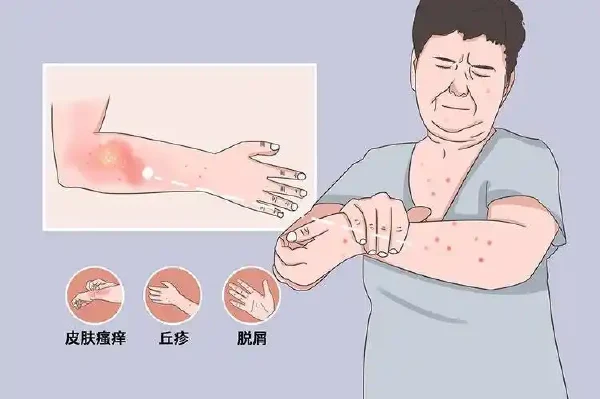 了解神经性皮炎及其综合治疗