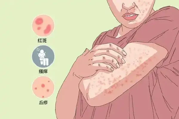 如何应对慢性荨麻疹:预防、治疗与自我管理指南