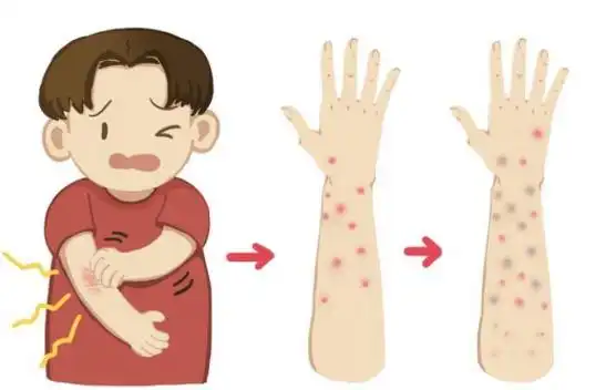 荨麻疹：认识它、治疗它、预防它封面图