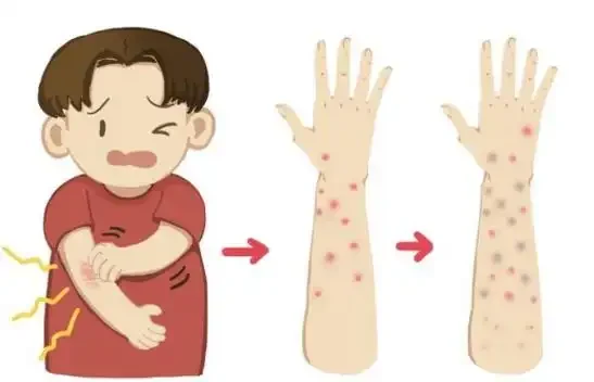 荨麻疹:认识它、治疗它、预防它