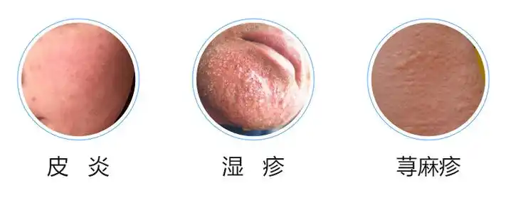过敏性<span style="color: #da4707">皮疹</span>：病因、诊断与综合管理