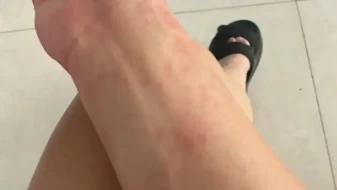 快速反应，科学防治：急性荨麻疹的应对与预防攻略