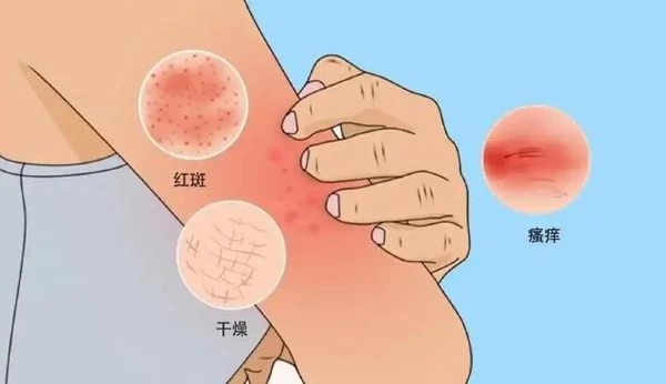 了解慢性荨麻疹:从症状到预防,全面解读