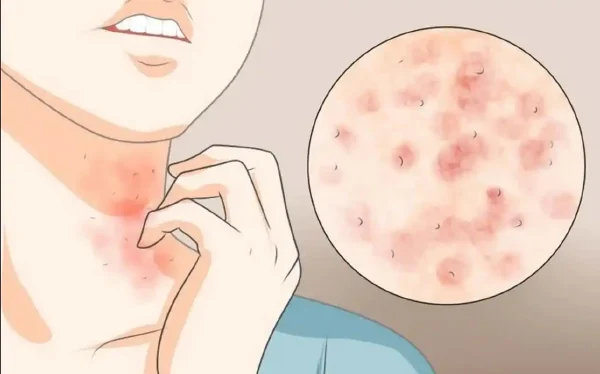 如何应对和预防慢性荨麻疹:从病因到治疗