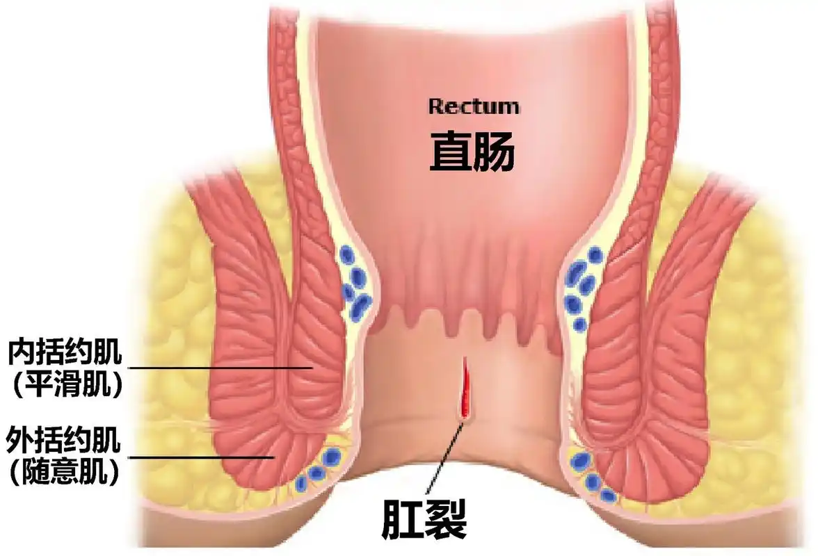 药物治疗肛裂：了解药物作用机制与安全用药！