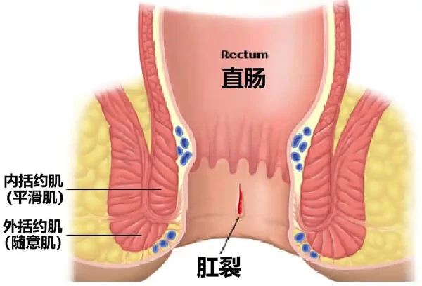 肛裂手术麻醉:如何平衡镇痛效果与术后恢复?