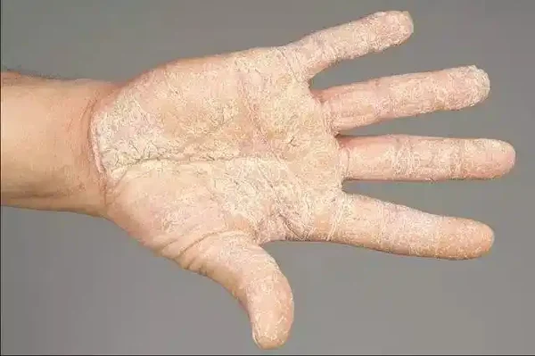 过敏性皮炎及其诊疗指南