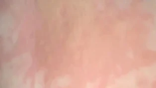 慢性荨麻疹与体虚,如何有效防治?