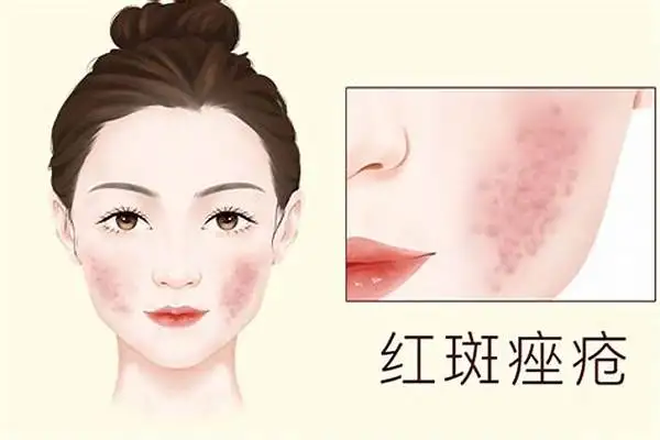 解密红斑狼疮:防护与治疗的详细指南