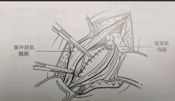 隐匿的危机！解读右腹股沟疝