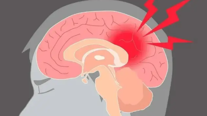 脑梗死并非老年人专属！它的真相让人心惊胆寒！封面图