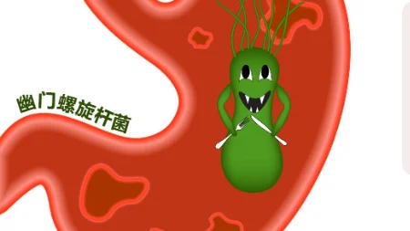 全面了解幽门螺杆菌感染:从诊断到治疗