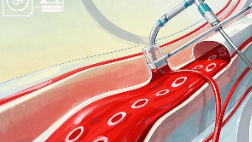 科普，血液透析<span style="color: #da4707">通路</span>：生命之桥的秘密与维护指南