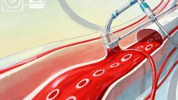 血液透析通路:生命之桥的秘密与维护指南