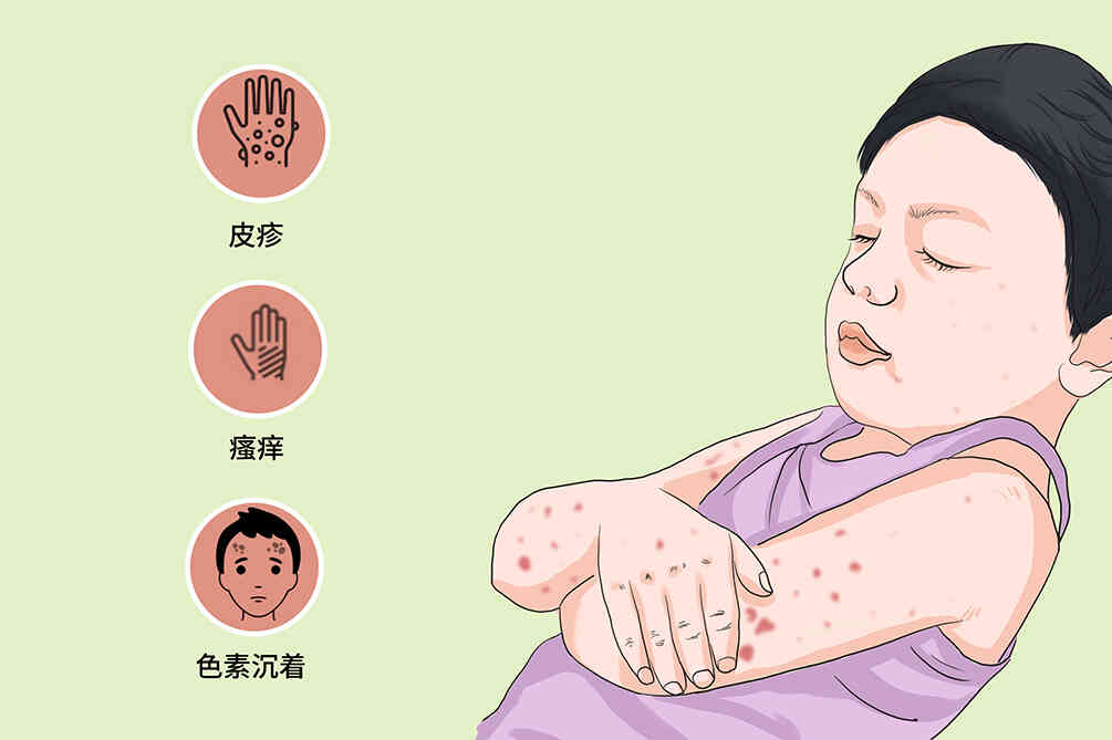 湿疹治疗，你需要了解的药物知识——让<span style="color: #da4707">生活</span>更<span style="color: #da4707">美好</span>！