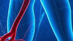 惊！您不可忽视的双下肢动脉粥样硬化闭塞症！