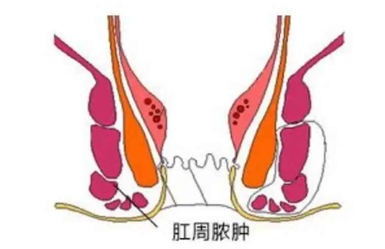 令人惊讶的<span style="color: #da4707">日常</span><span style="color: #da4707">小病</span>——解析肛周脓肿的真相！