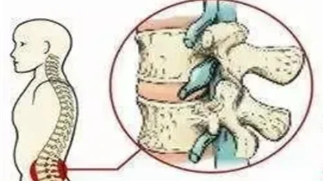 腰椎间盘突出手术的麻醉管理：如何确保安全与效果？