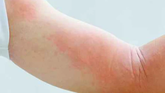 急性荨麻疹:你需要了解的应对措施和预防方法