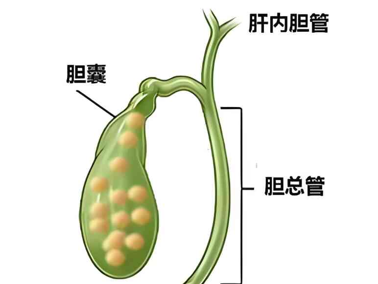 <span style="color: #da4707">胆囊结石</span>——你了解多少？