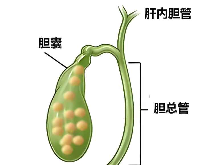 <span style="color: #da4707">胆囊结石</span>——你了解多少？