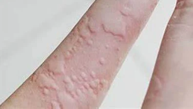 慢性荨麻疹：全面了解与科学管理