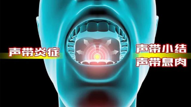 声带息肉：从病因到康复的全指南封面图