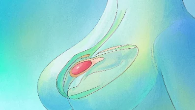乳腺癌早期信号与防控指南，女性必看！