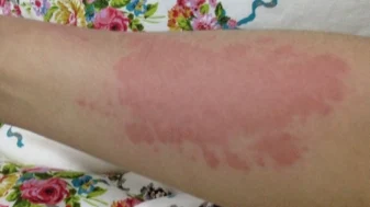 解密慢性荨麻疹：症状、治疗及预防解析