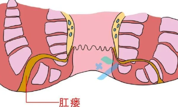 肛瘘：别让它影响你的健康生活！