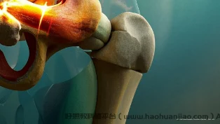 深入了解右股骨颈骨折：从分类到治疗的全面解析