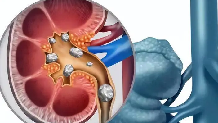 肾结石的秘密：如何预防和管理