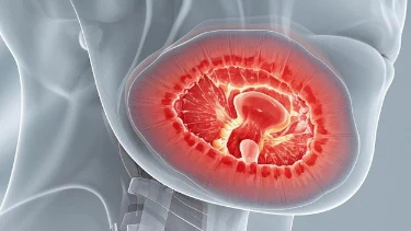 了解慢性咽炎及其治疗:科学管理你的咽喉健康