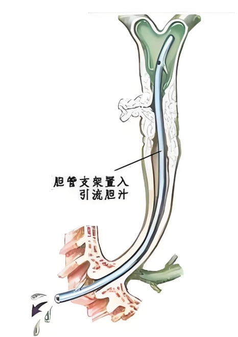 揭秘胆管支架及其术后护理：您需要知道的一切