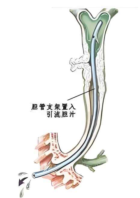 科普，揭秘胆管<span style="color: #da4707">支架</span>及其术后护理：您需要知道的一切！
