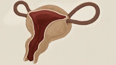 子宫多发平滑肌瘤的全面解析与管理