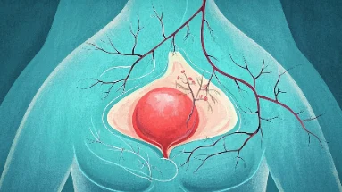 早期乳腺癌诊断:现代技术为患者带来新希望