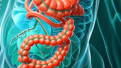 结肠憩室炎揭秘：我们该如何预防这“隐形杀手”