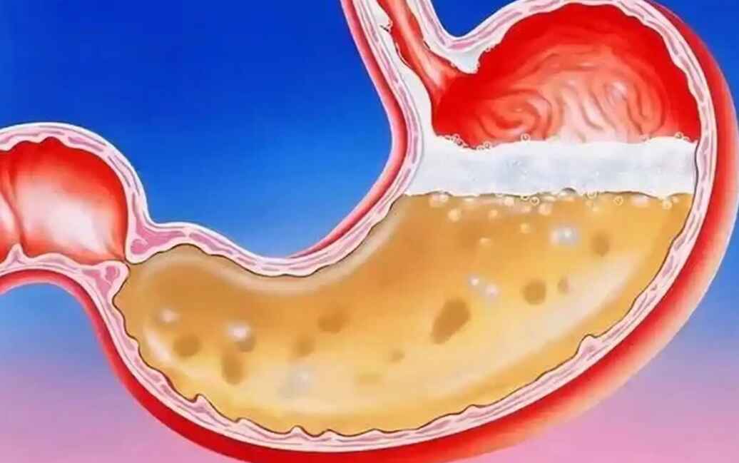 科普，反流性食管炎：从类型到治疗，你需要了解的一切封面图