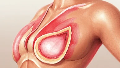 晚期乳腺癌晚期患者如何应对——从生活习惯到治疗方案,全面解读