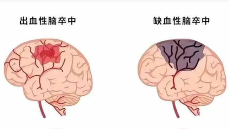 神经系统的“定时炸弹”：看懂<span style="color: #da4707">脑卒中</span>的预防和治疗