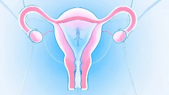 全面解析宫颈癌早期诊断与治疗:全方位守护女性健康