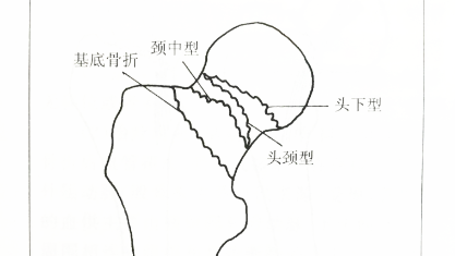 科普，<span style="color: #da4707">老年</span>人<span style="color: #da4707">股骨</span>颈<span style="color: #da4707">骨折</span>的诊断与治疗