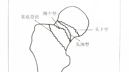 老年人股骨颈骨折的诊断与治疗