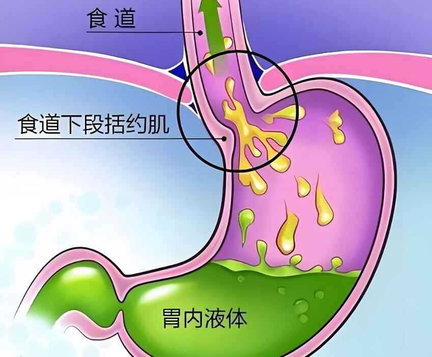 胃食管反流与<span style="color: #da4707">脱发</span>：全面了解及科学管理