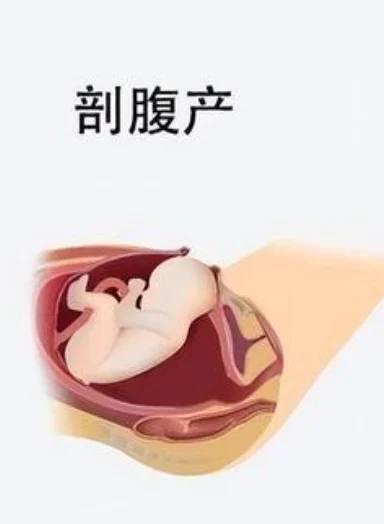 手术中的惊险时刻!——一例妊娠37周的剖宫产手术详解