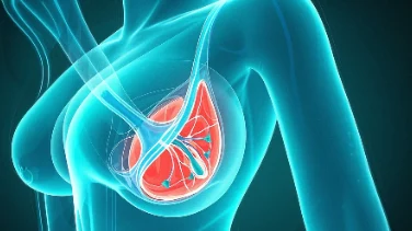 预警!乳腺癌早期症状与应对指南