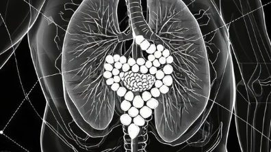 直肠癌晚期:揭开肺、骨及腹膜转移的治疗迷雾