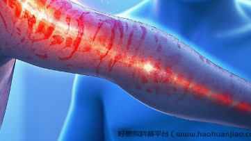 科普，荨麻疹，别忽视“小疹子”带来的大困扰！封面图